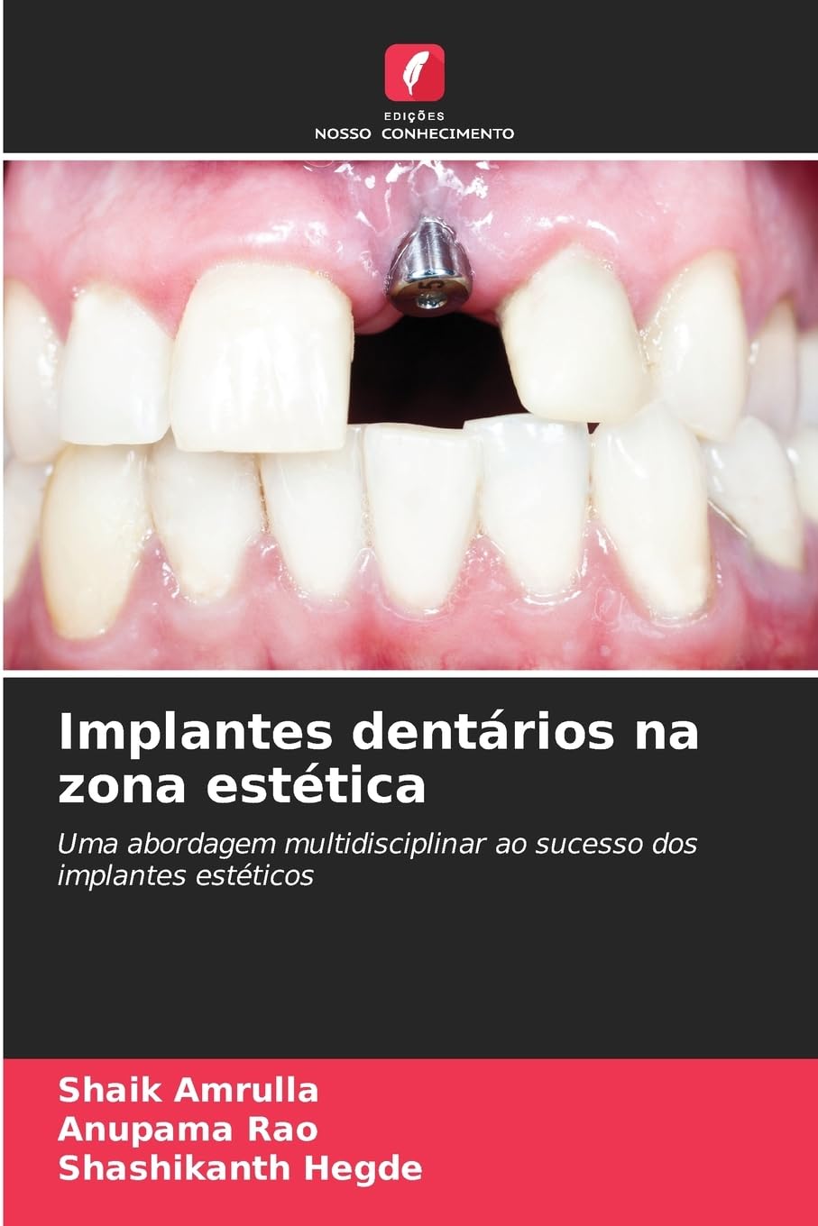 Implantes dentários na zona estética Medicine