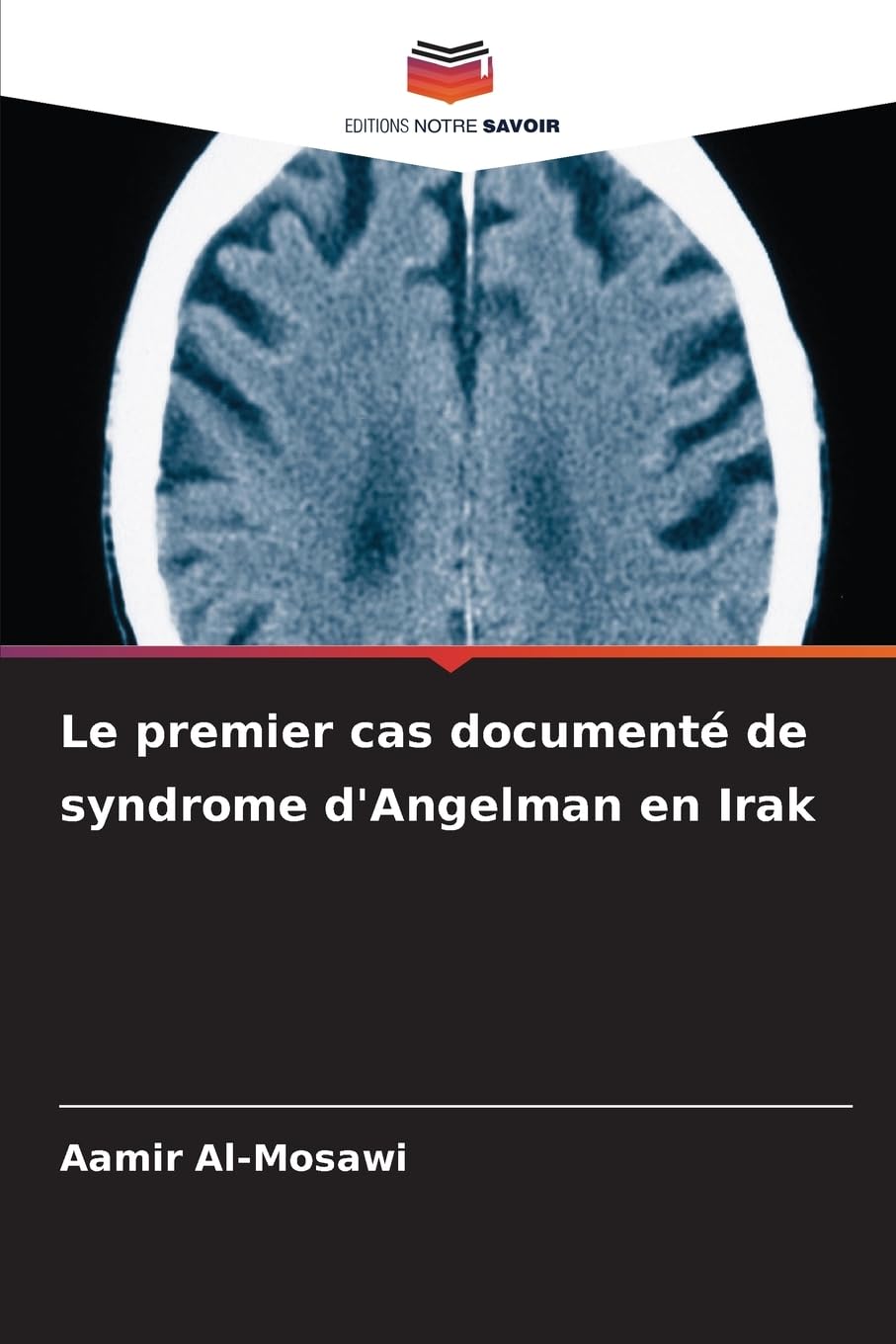 Le premier cas documenté de syndrome d'Angelman en Irak Medicine