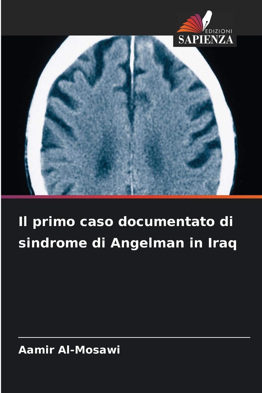 Il primo caso documentato di sindrome di Angelman in Iraq Medicine