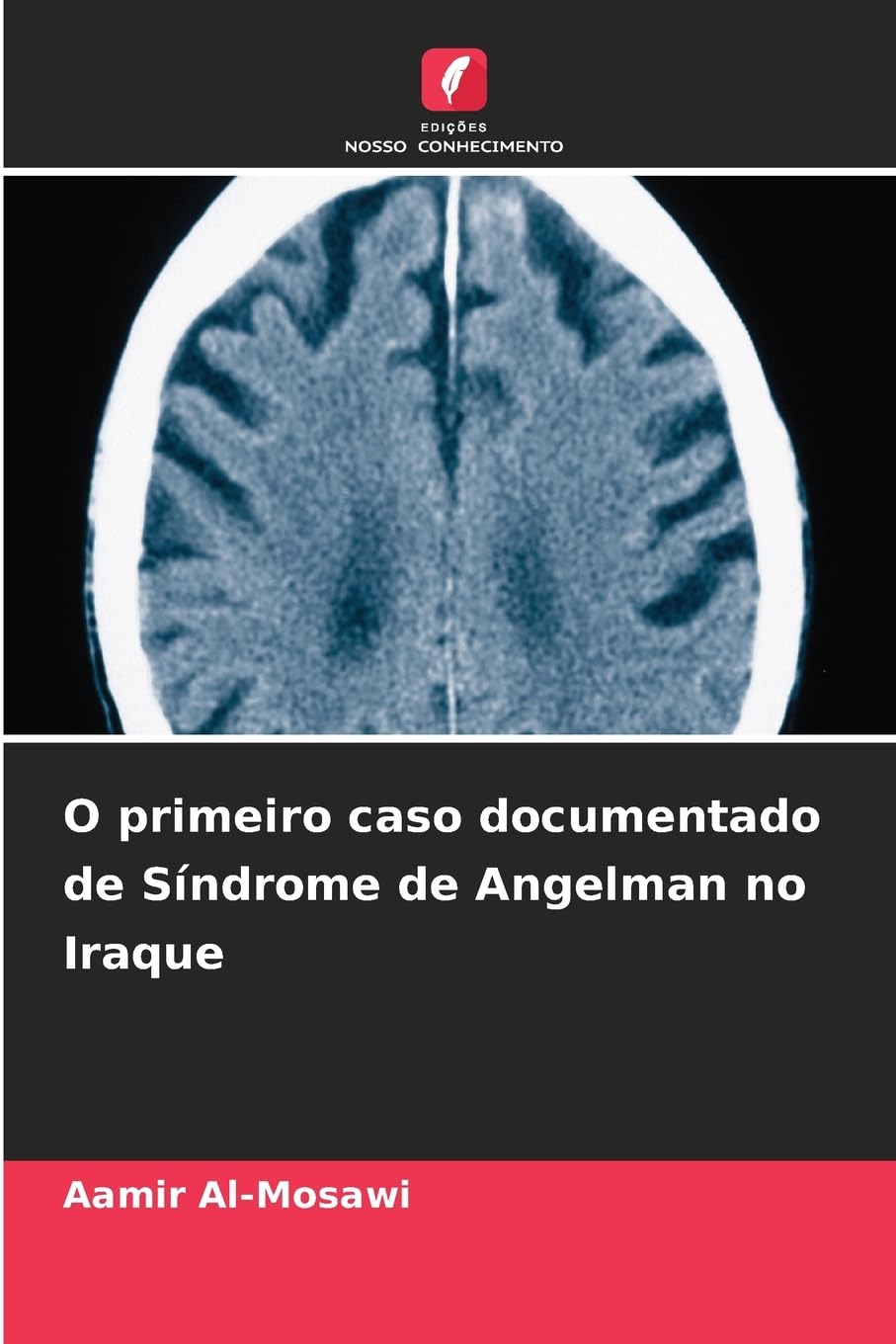 O primeiro caso documentado de Síndrome de Angelman no Iraque Medicine