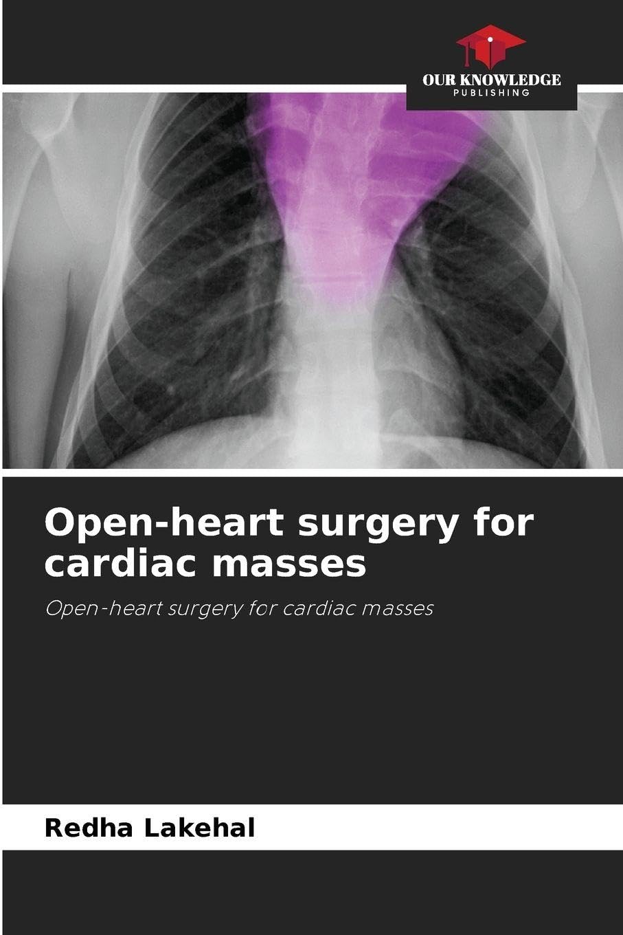 Open-heart surgery for cardiac masses Medicine
