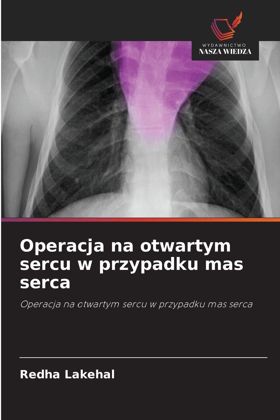Operacja na otwartym sercu w przypadku mas serca Medicine