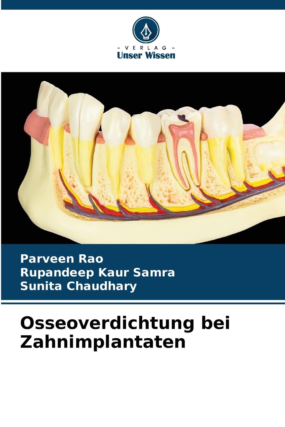 Osseoverdichtung bei Zahnimplantaten Medicine