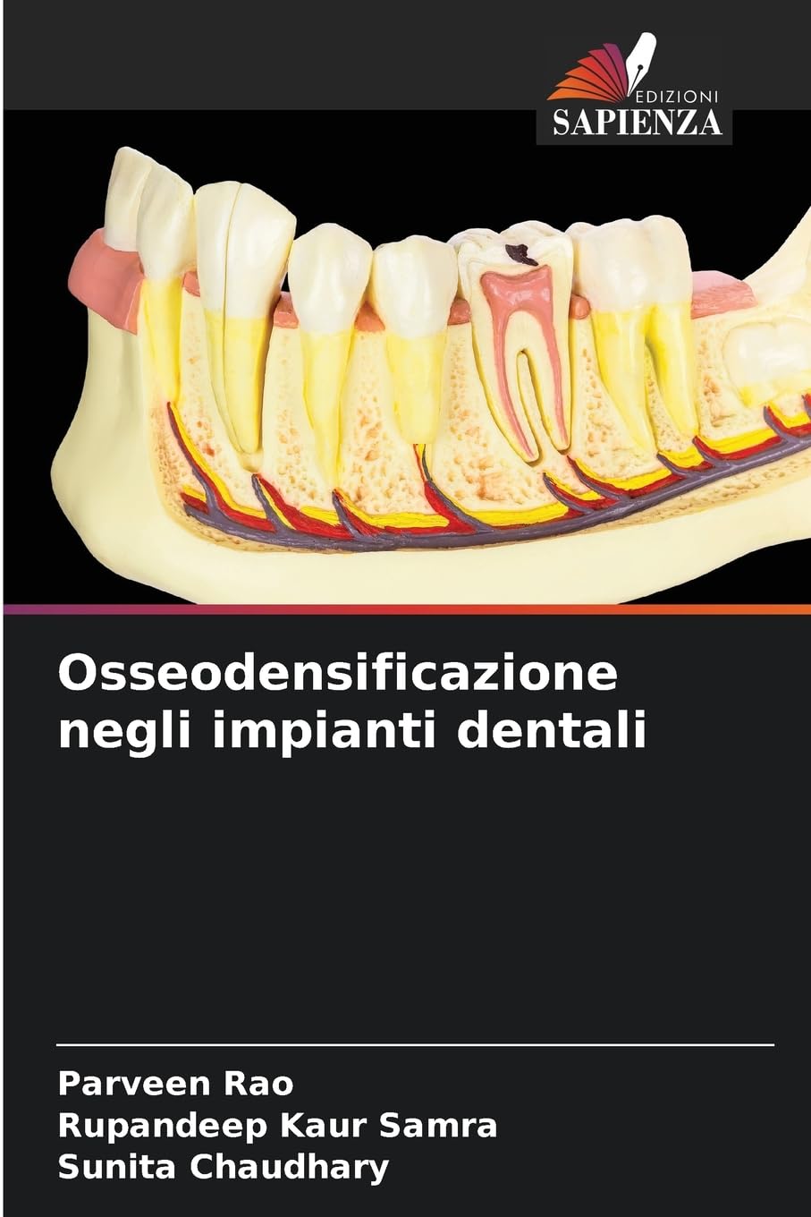 Osseodensificazione negli impianti dentali Medicine