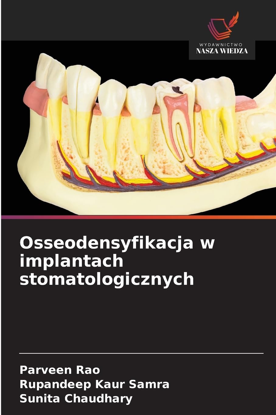 Osseodensyfikacja w implantach stomatologicznych Medicine
