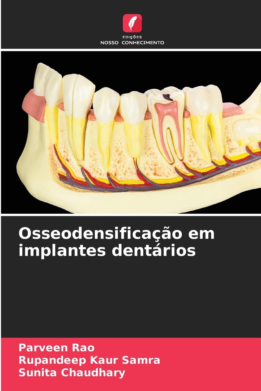 Osseodensificação em implantes dentários Medicine