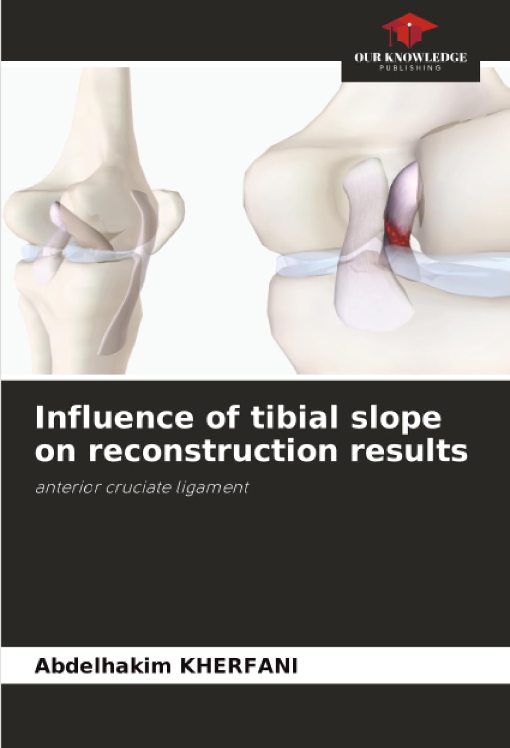 Influence of tibial slope on reconstruction results Medicine