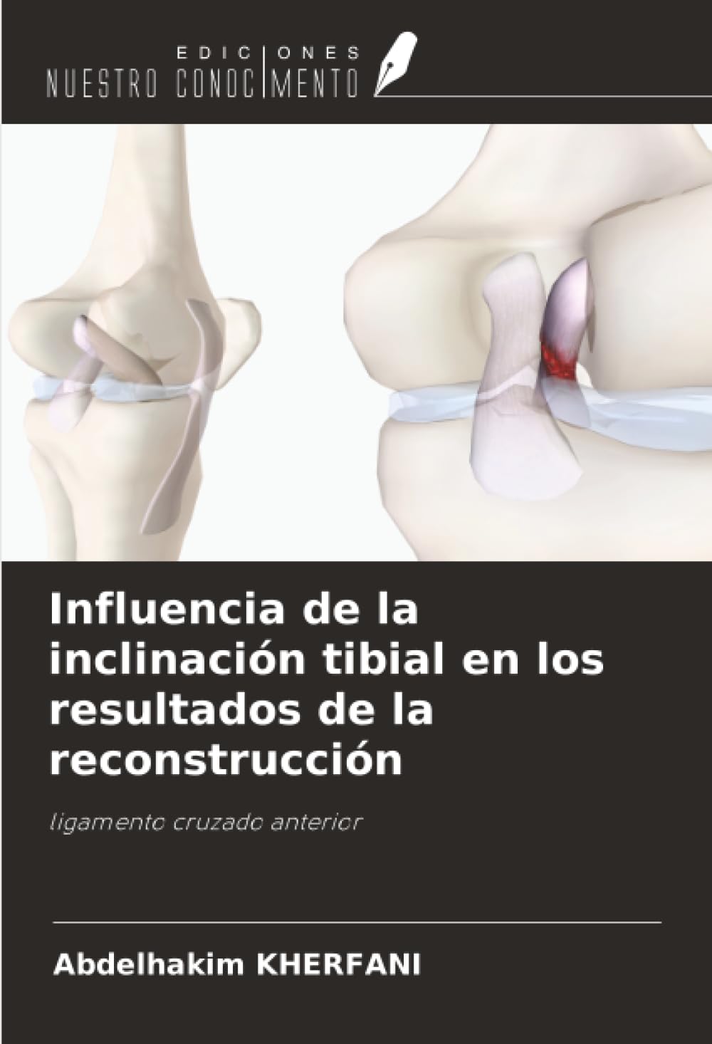 Influencia de la inclinación tibial en los resultados de la reconstrucción Medicine