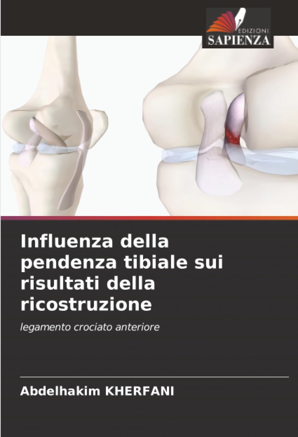 Influenza della pendenza tibiale sui risultati della ricostruzione Medicine