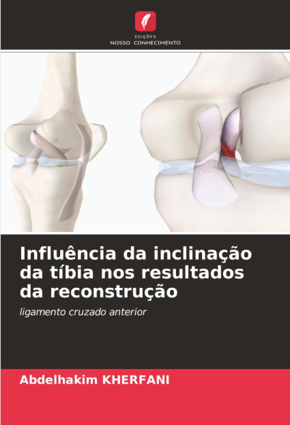Influência da inclinação da tíbia nos resultados da reconstrução Medicine