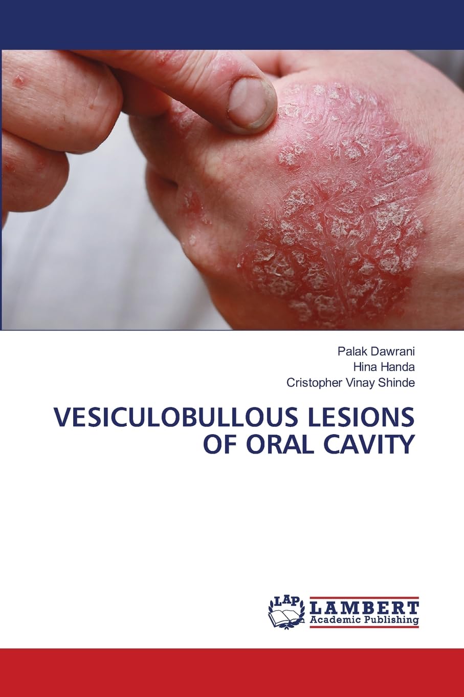 VESICULOBULLOUS LESIONS OF ORAL CAVITY Medicine