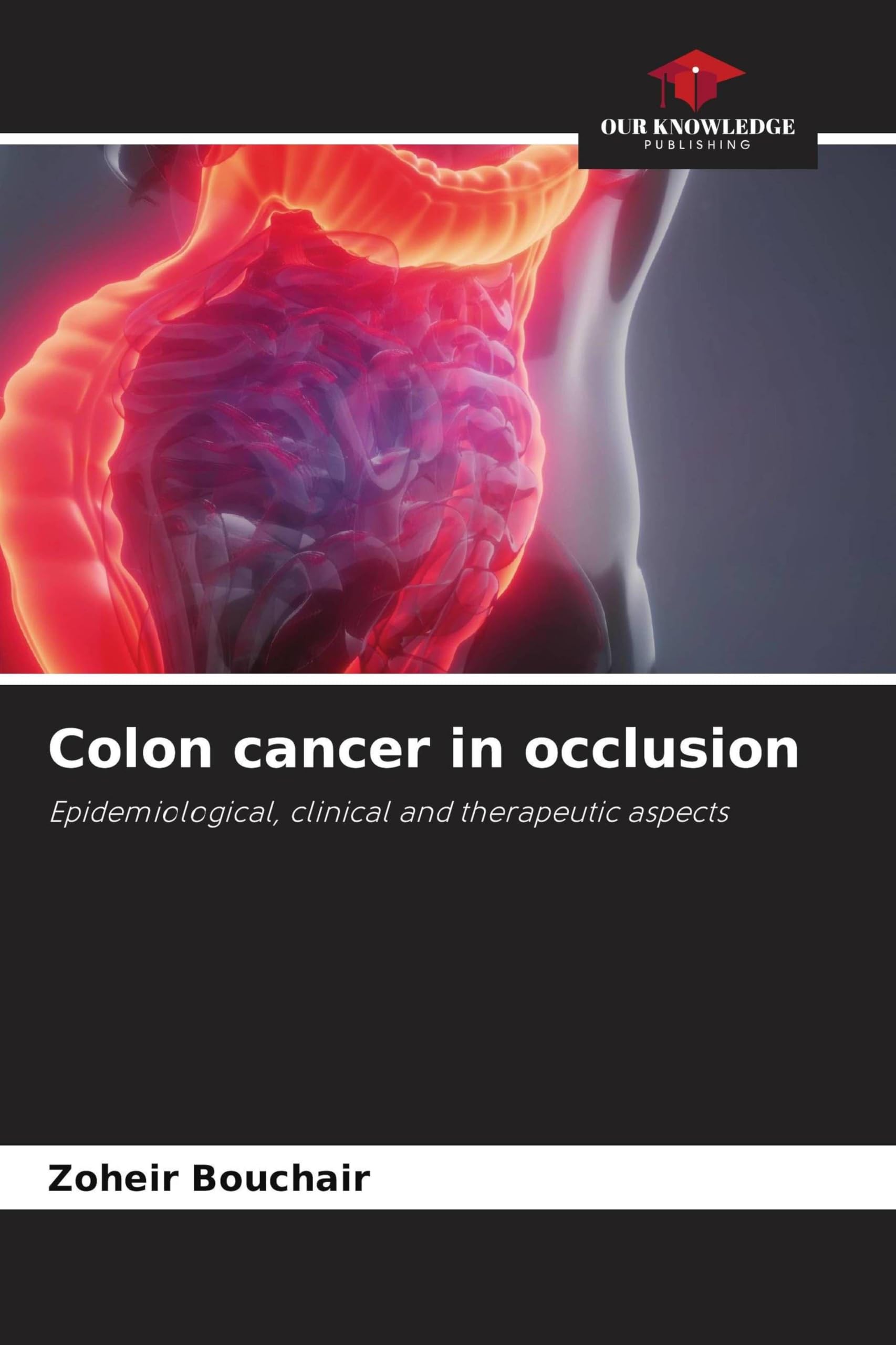 Colon cancer in occlusion Medicine