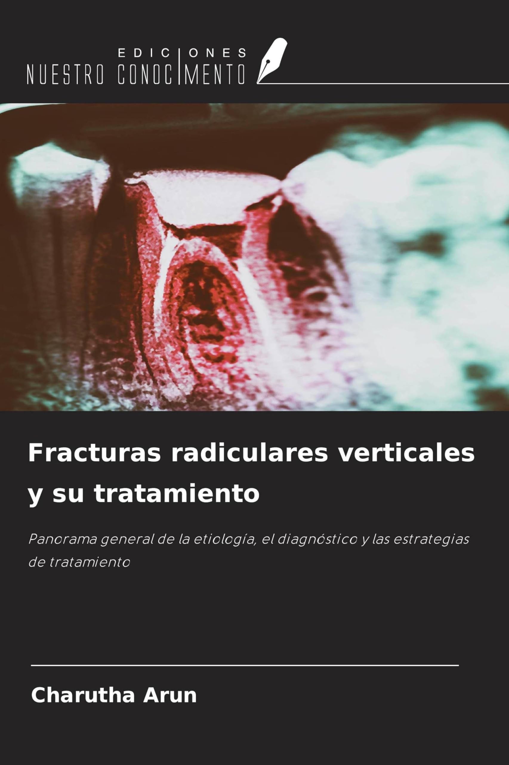 Fracturas radiculares verticales y su tratamiento Medicine