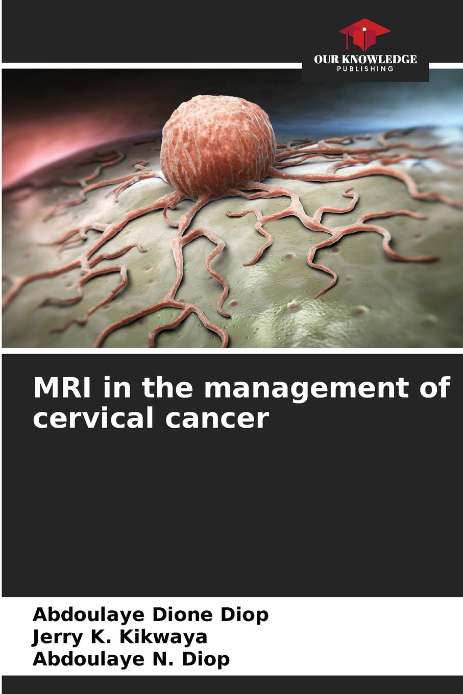 MRI in the management of cervical cancer Medicine
