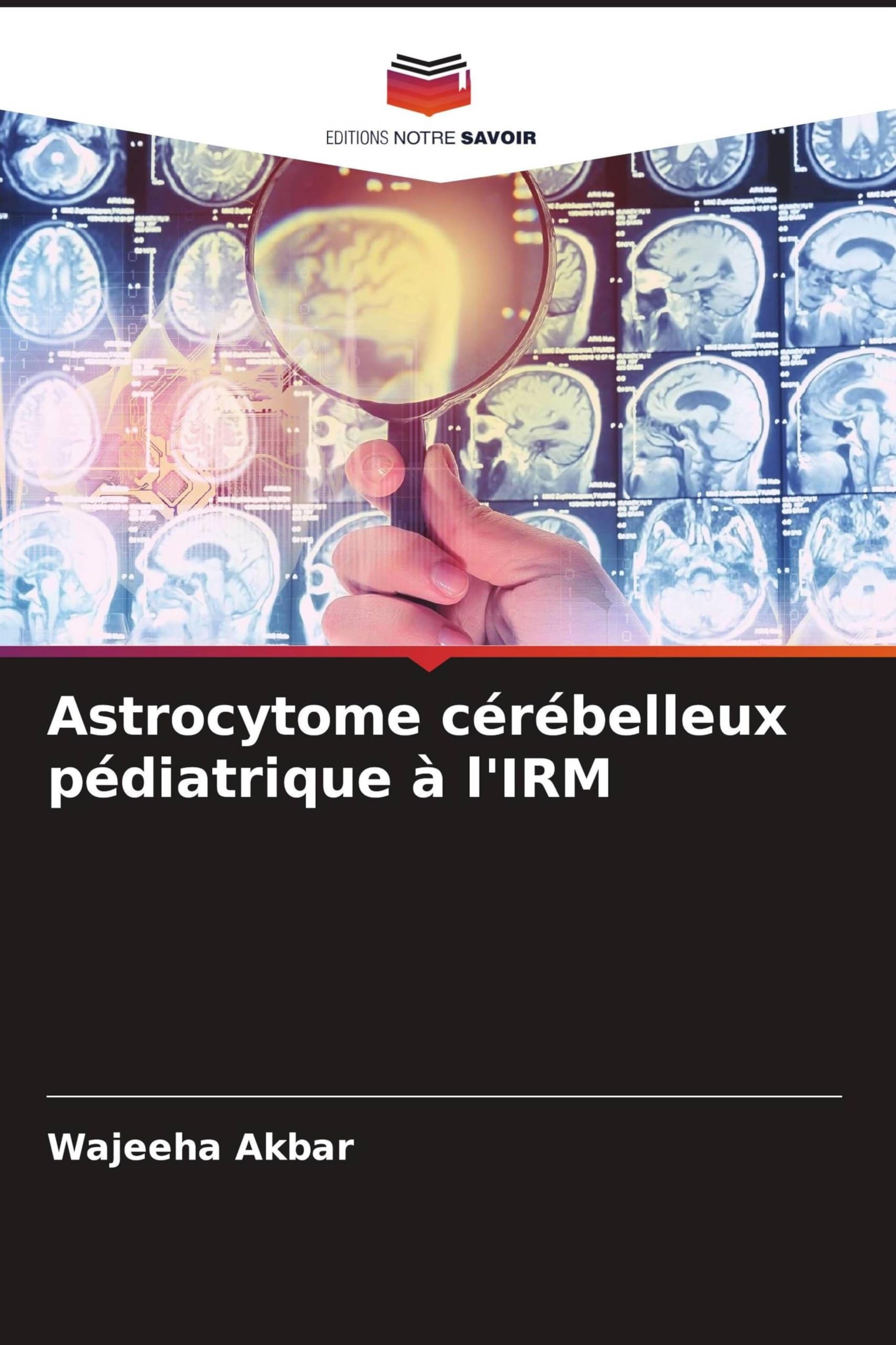 Astrocytome cérébelleux pédiatrique à l'IRM: DE Medicine