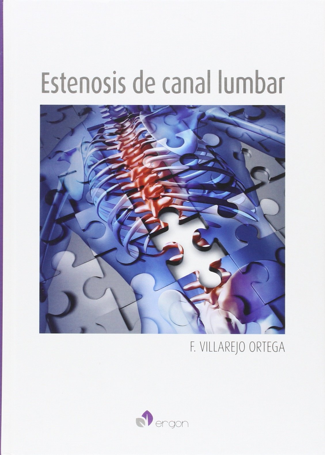 Estenosis del canal lumbar Medicine