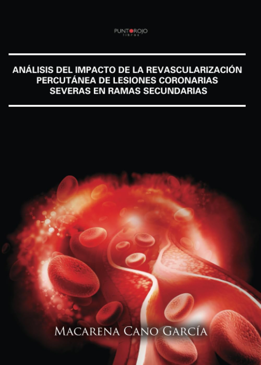 Análisis del impacto de la revascularización percutánea de lesiones coronarias severas en ramas secundarias Medicine