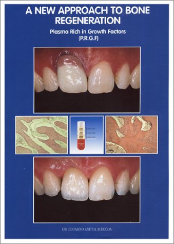 A New Approach to Bone Regeneration: Plasma Rich in Growth Factors (PRGF) Books