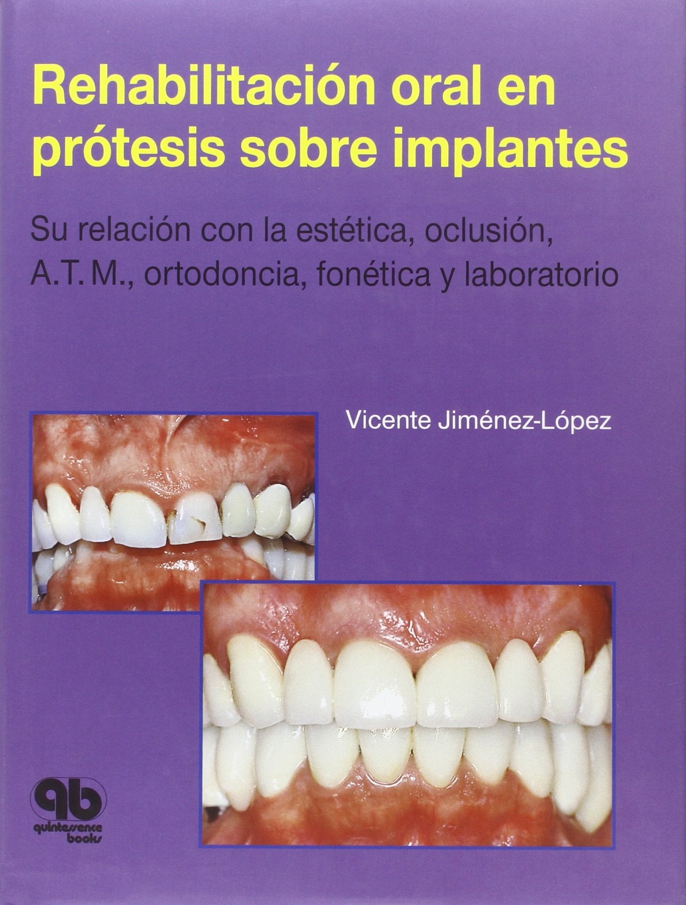 Rehabilitación oral en prótesis sobre implantes: Su relación con la estética, oclusión, A.T.M., ortodoncia, fonética y laboratorio book
