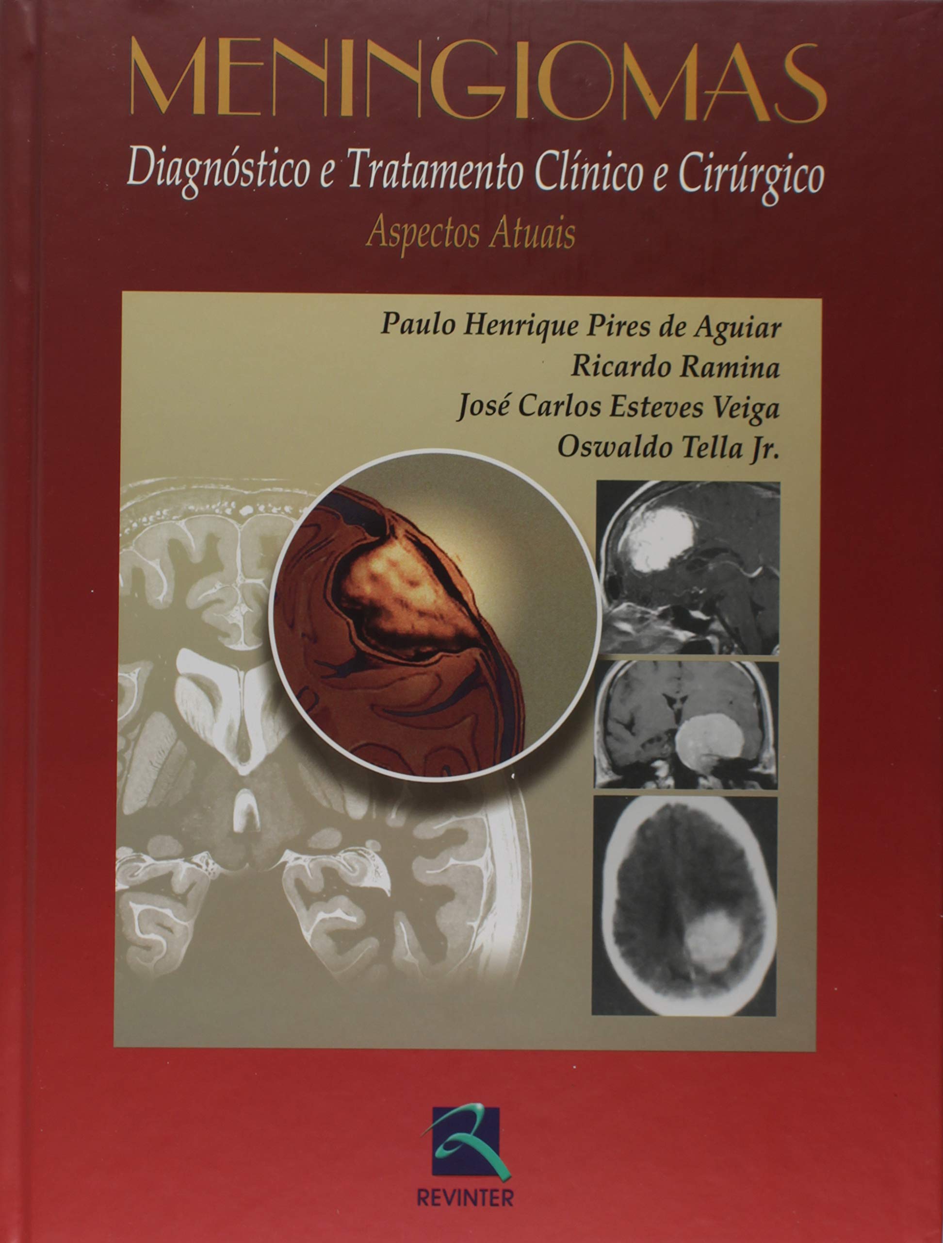 Meningiomas Diagnostico E Tratamento Clinico E Cirurgico. Diagnostico E Tratamento Clinico Books