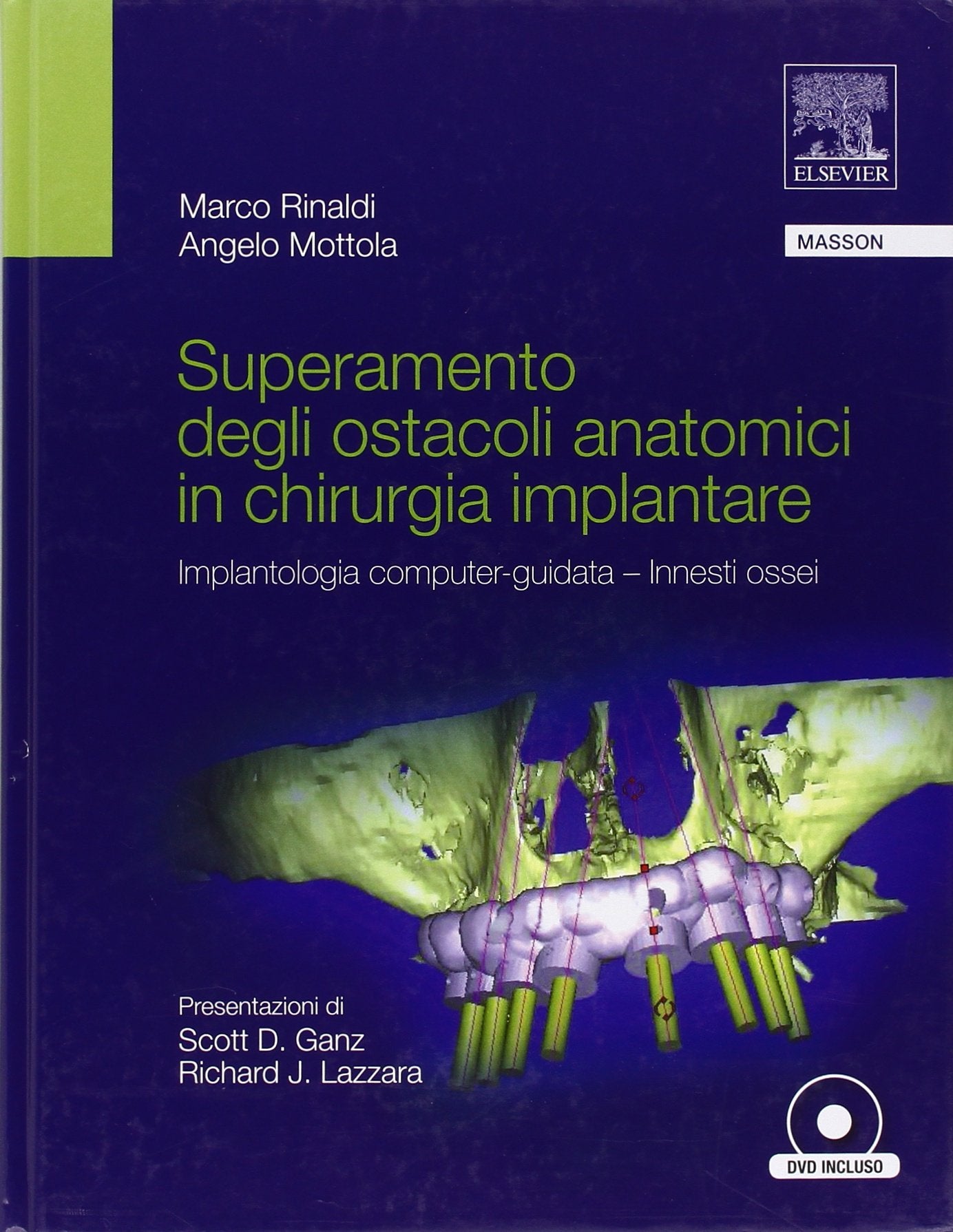 Superamento degli ostacoli anatomici in chirurgia implantare. Implantologia computer-guidata innesti ossei. Con DVD book