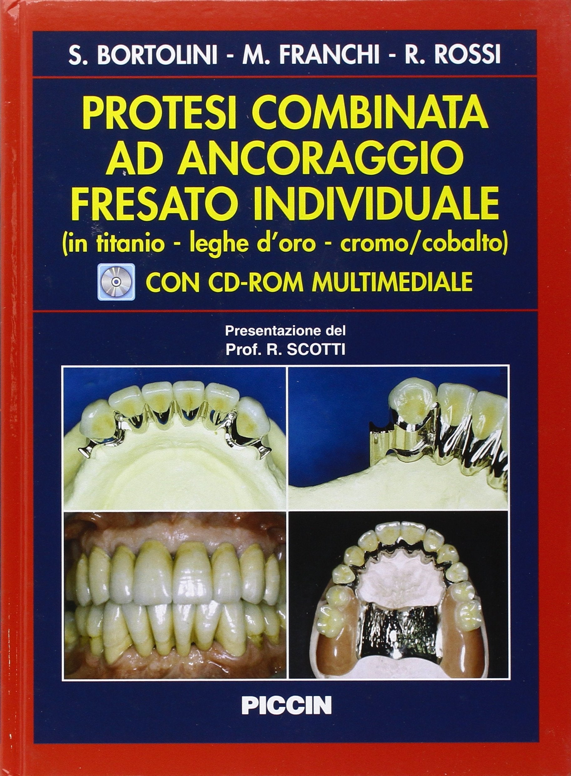 Protesi combinata ad ancoraggio fresato individuale (titanio, leghe d'oro, cromo, cobalto) Medicine
