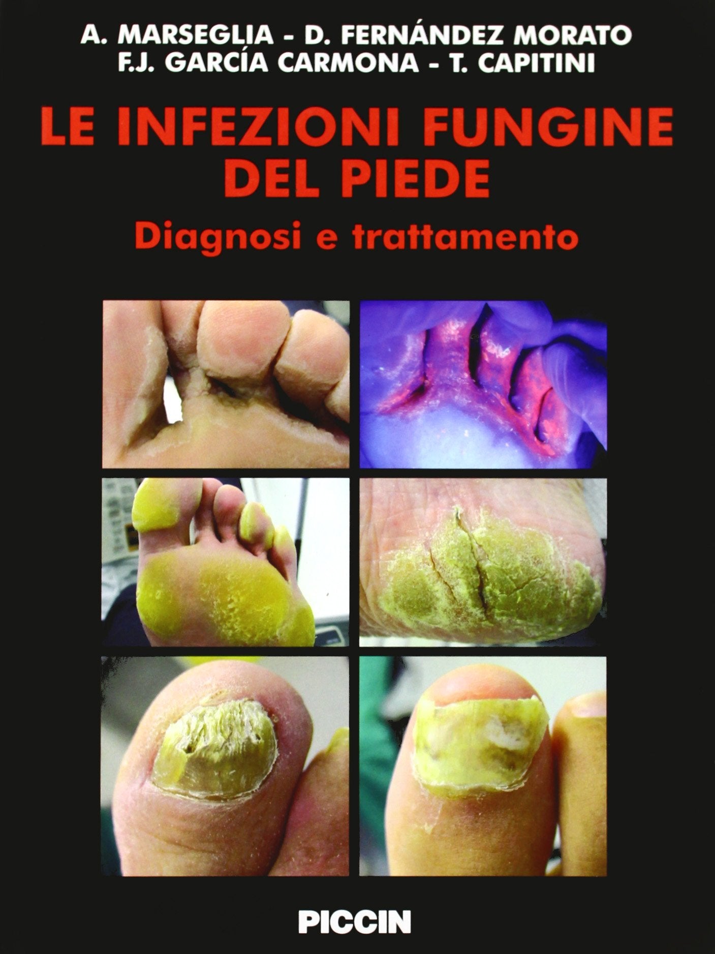 Le infezioni fungine del piede. Diagnosi e trattamento book