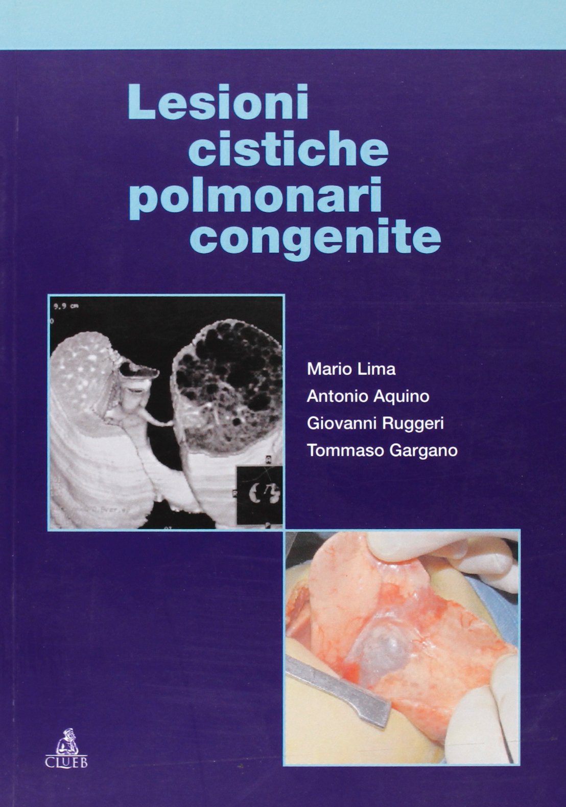 Lesioni cistiche polmonari congenite Medicine