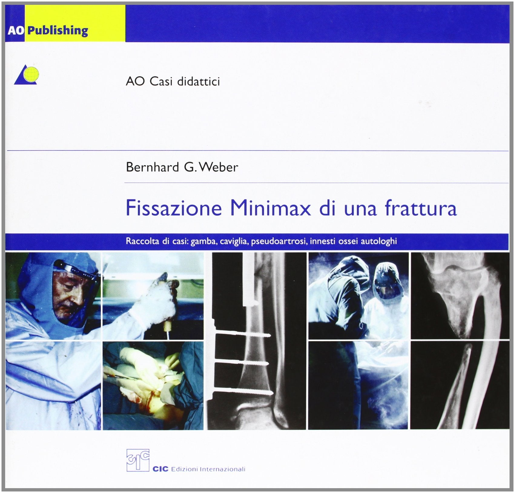 Fissazione minimax di una frattura Medicine