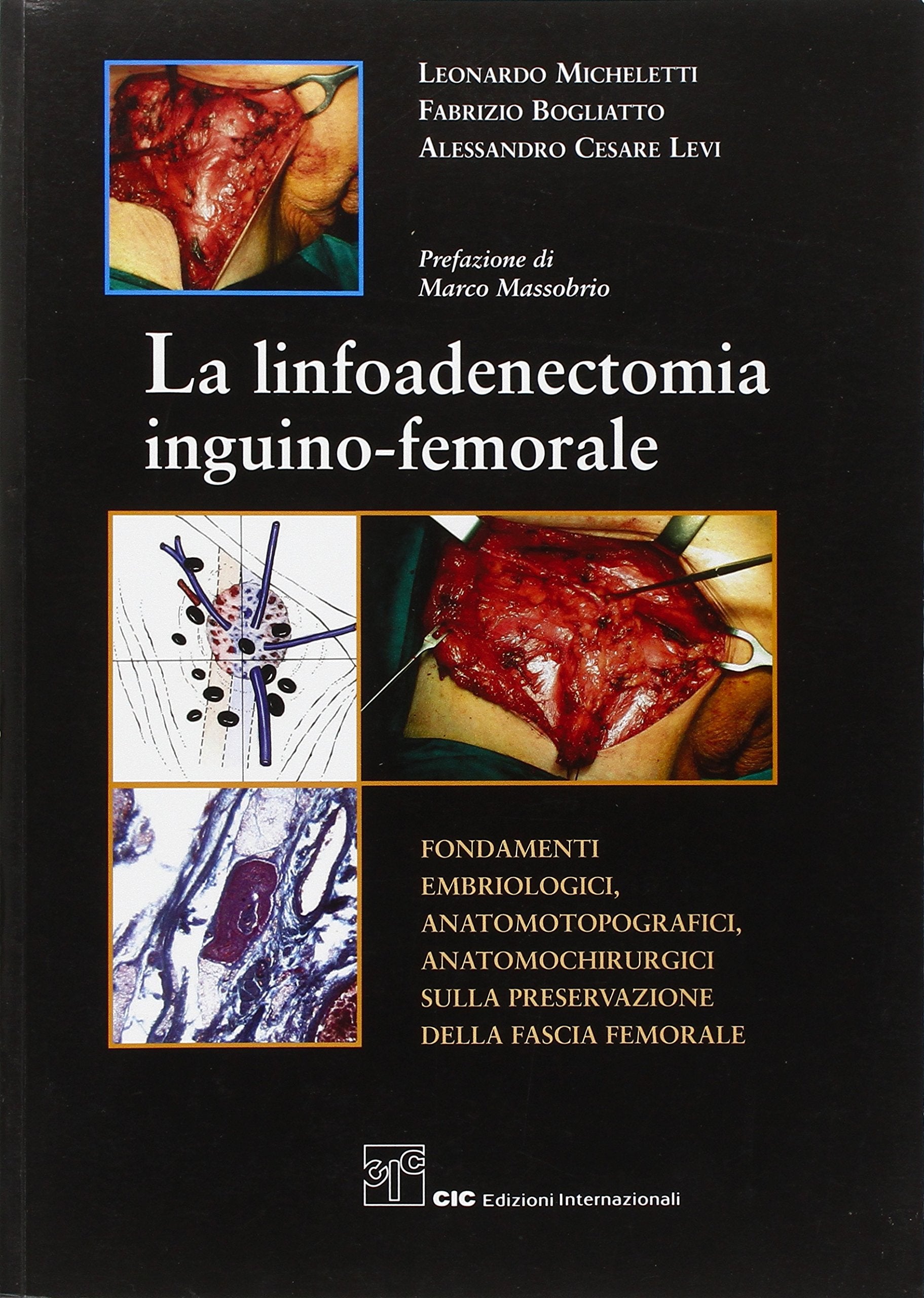 La linfoadenectomia inguino-femorale. Fondamenti embriologici, anatomotopografici, anatomochirurgici sulla preservazione della fascia femorale Medicine