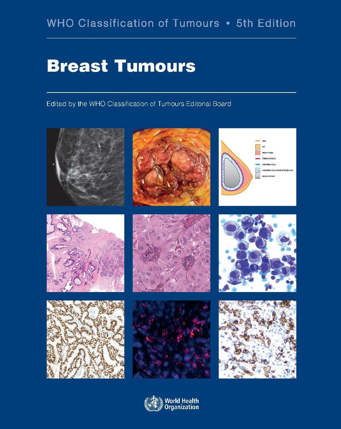 Breast Tumours Medicine