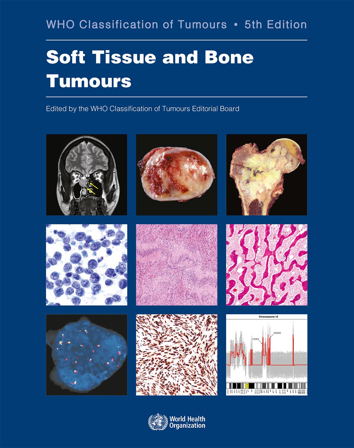 Soft Tissue and Bone Tumours: Who Classification of Tumours (World Health Organization Classification of Tumours, 3, Band 3) Medicine