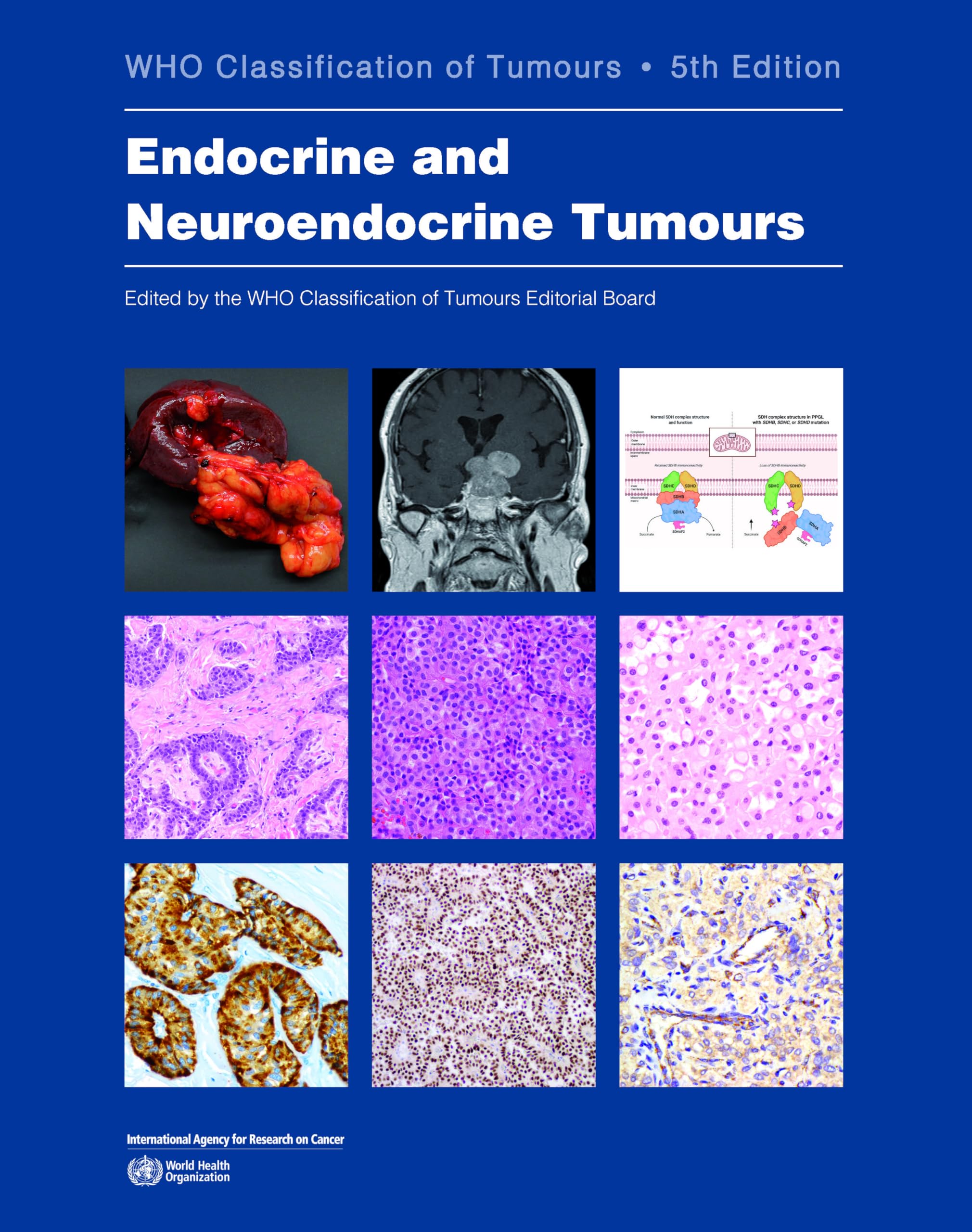 Endocrine and Neuroendocrine Tumours: Who Classification of Tumours Medicine