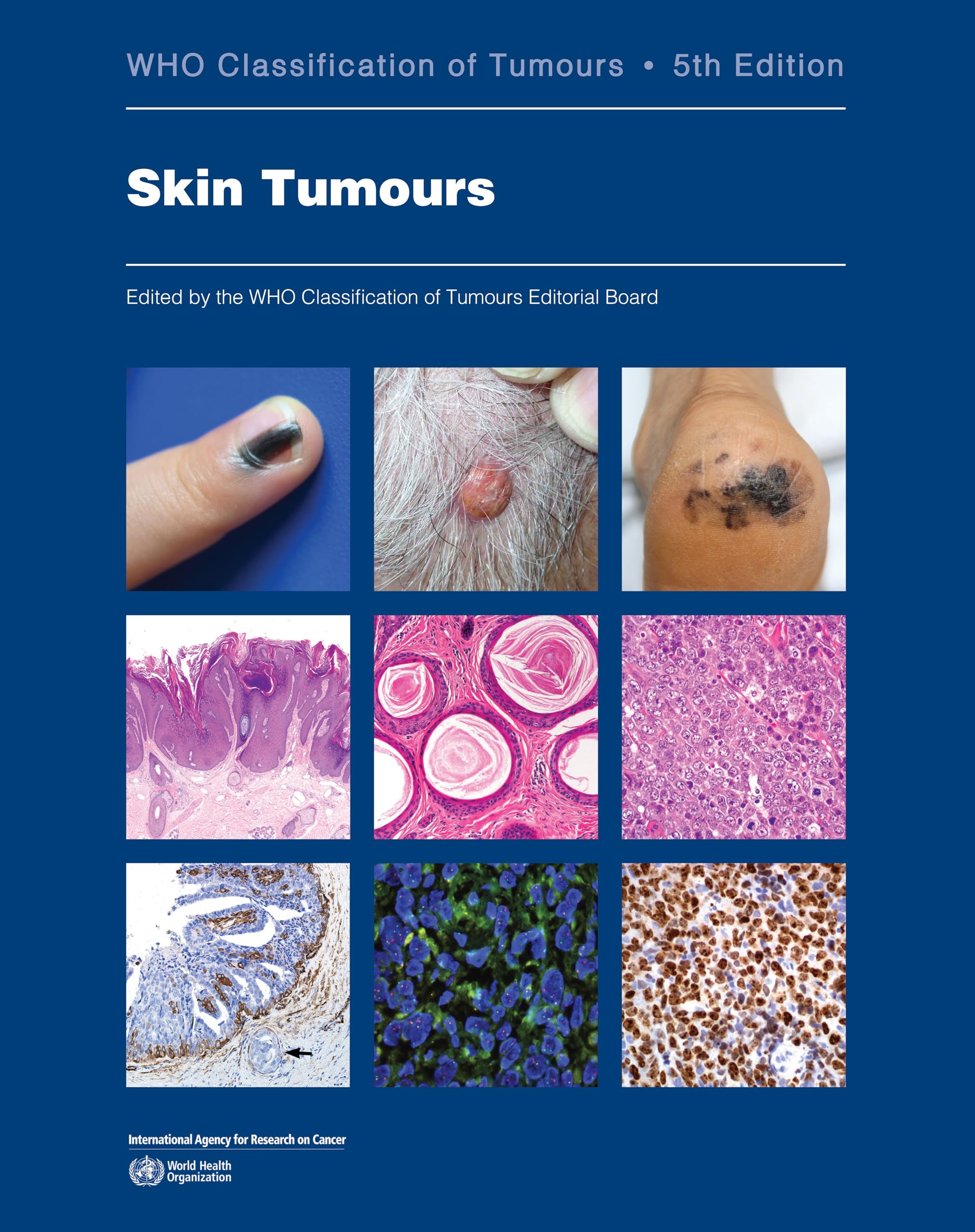 Skin Tumours Medicine