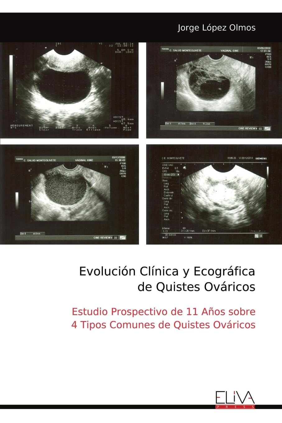 Evolución Clínica y Ecográfica de Quistes Ováricos Medicine