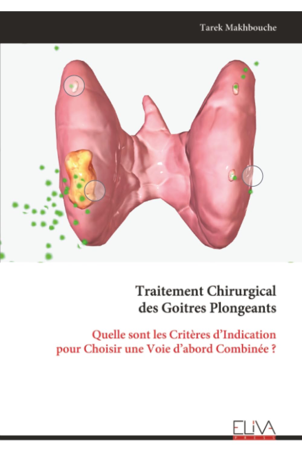 Traitement Chirurgical des Goitres Plongeants Medicine