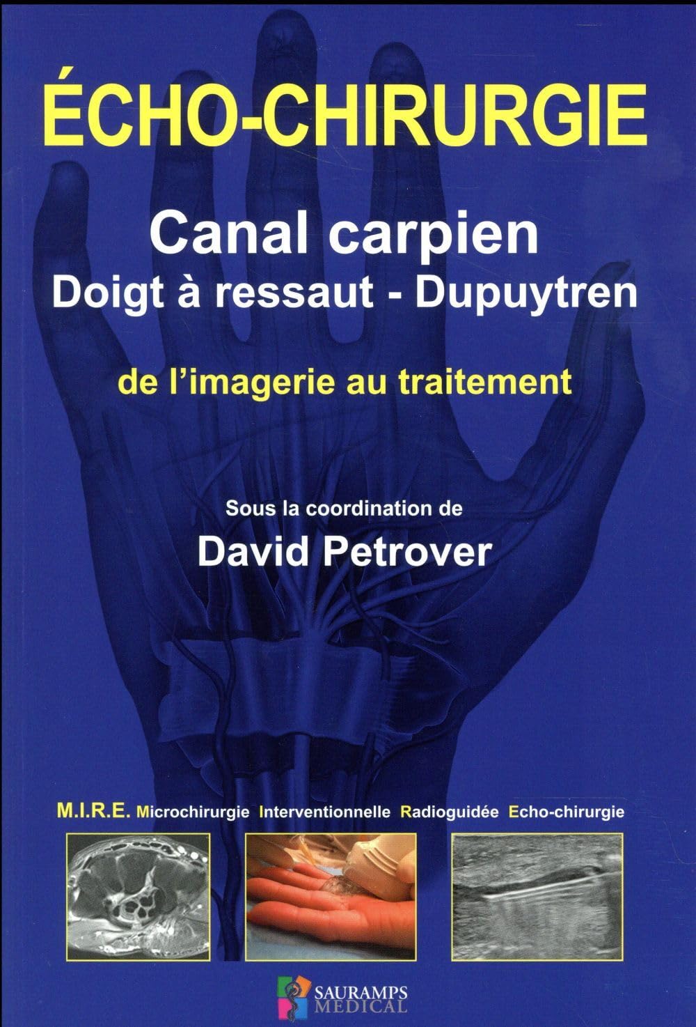 ECHO-CHIRURGIE CANAL CARPIEN, DOIGT A RESSAUT ET DUPUYTREN: De l'imagerie au traitement Medicine
