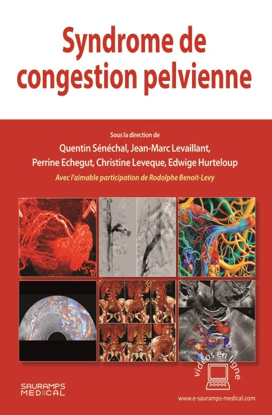 Syndrome de congestion pelvienne Medicine