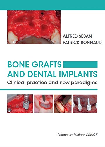 Bone Grafts and Dental Implants : Clinical practice and new paradigms book