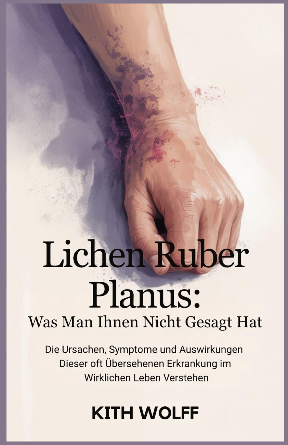 Lichen ruber planus: Was man Ihnen nicht gesagt hat: Die Ursachen, Symptome und Auswirkungen dieser oft übersehenen Erkrankung im wirklichen Leben verstehen Medicine
