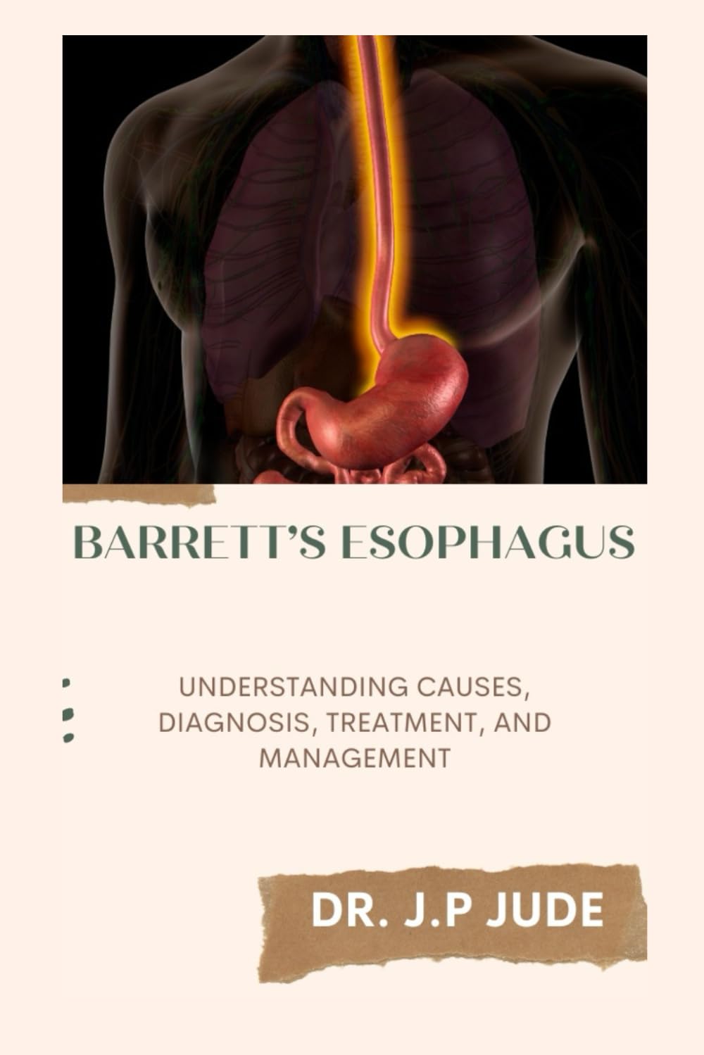 BARRETT’S ESOPHAGUS: UNDERSTANDING CAUSES, DIAGNOSIS, TREATMENT, AND MANAGEMENT Medicine
