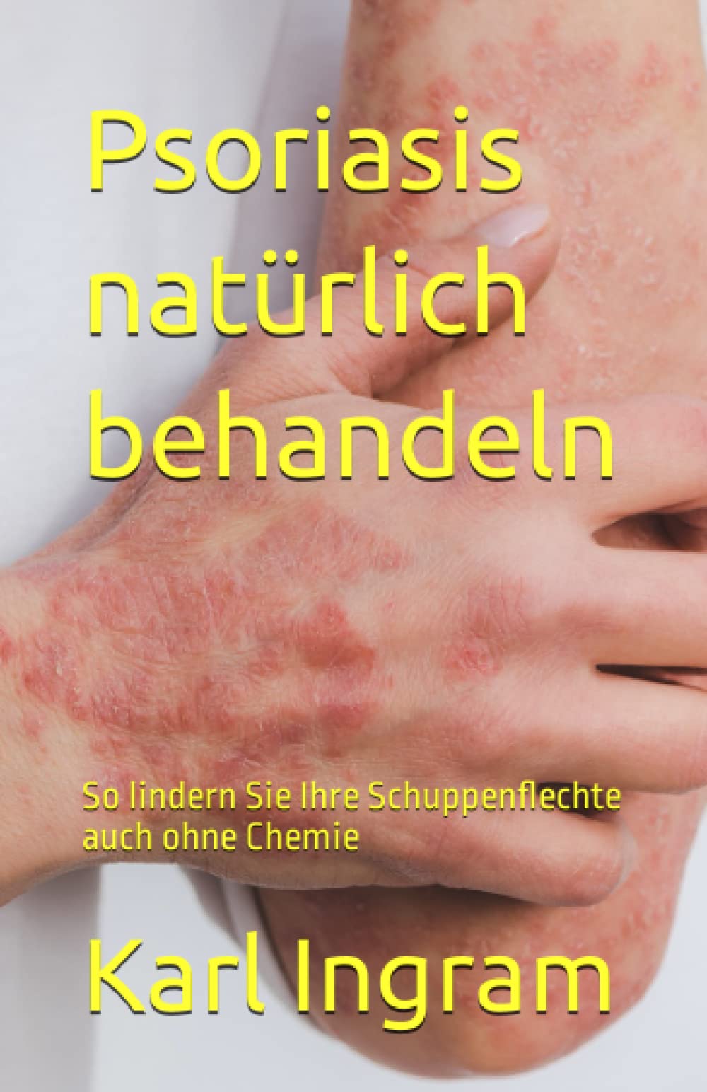 Psoriasis natürlich behandeln: So lindern Sie Ihre Schuppenflechte auch ohne Chemie Medicine