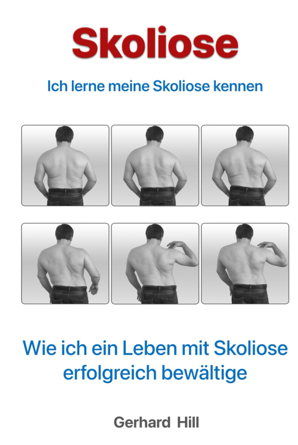 Skoliose: Ich lerne meine Skoliose kennen Health, Nutrition & Fitness