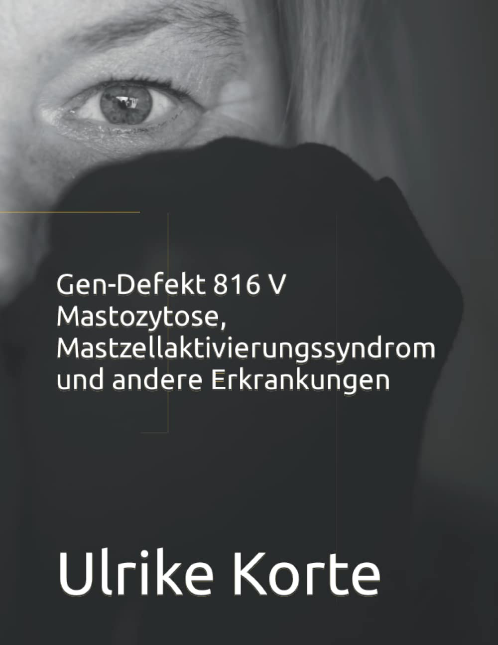 Gen-Defekt 816 V Mastozytose, Mastzellaktivierungssyndrom und andere Erkrankungen Medicine